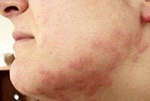 Bedbug_bites