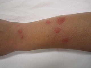 Bed bug bite marks - bpcsindia.co.in Bed Bug Bite Mark